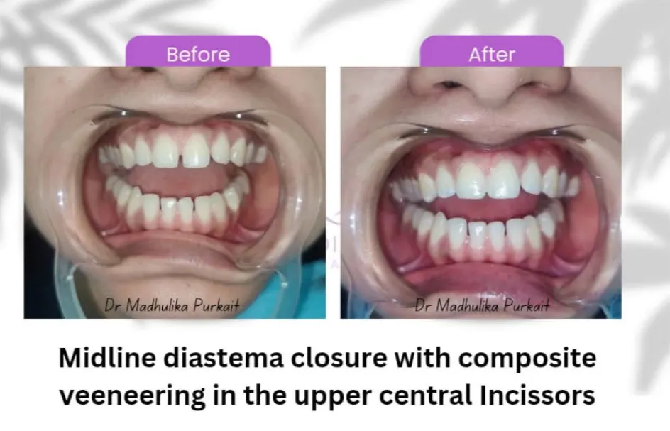 Before and after: a midline gap between the upper central incisors closed with composite veneers