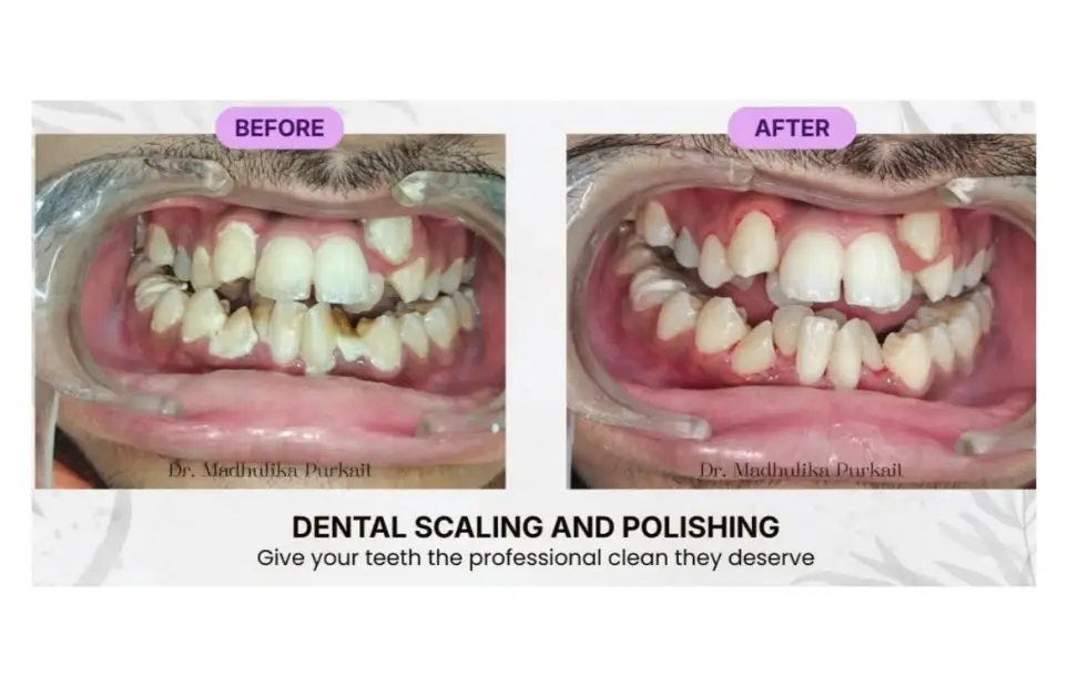 Before and after: dental scaling and polishing removing deposits along the gum line