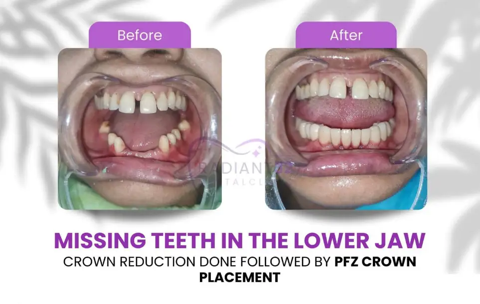 Before and after: missing lower teeth restored with PFZ crown placement