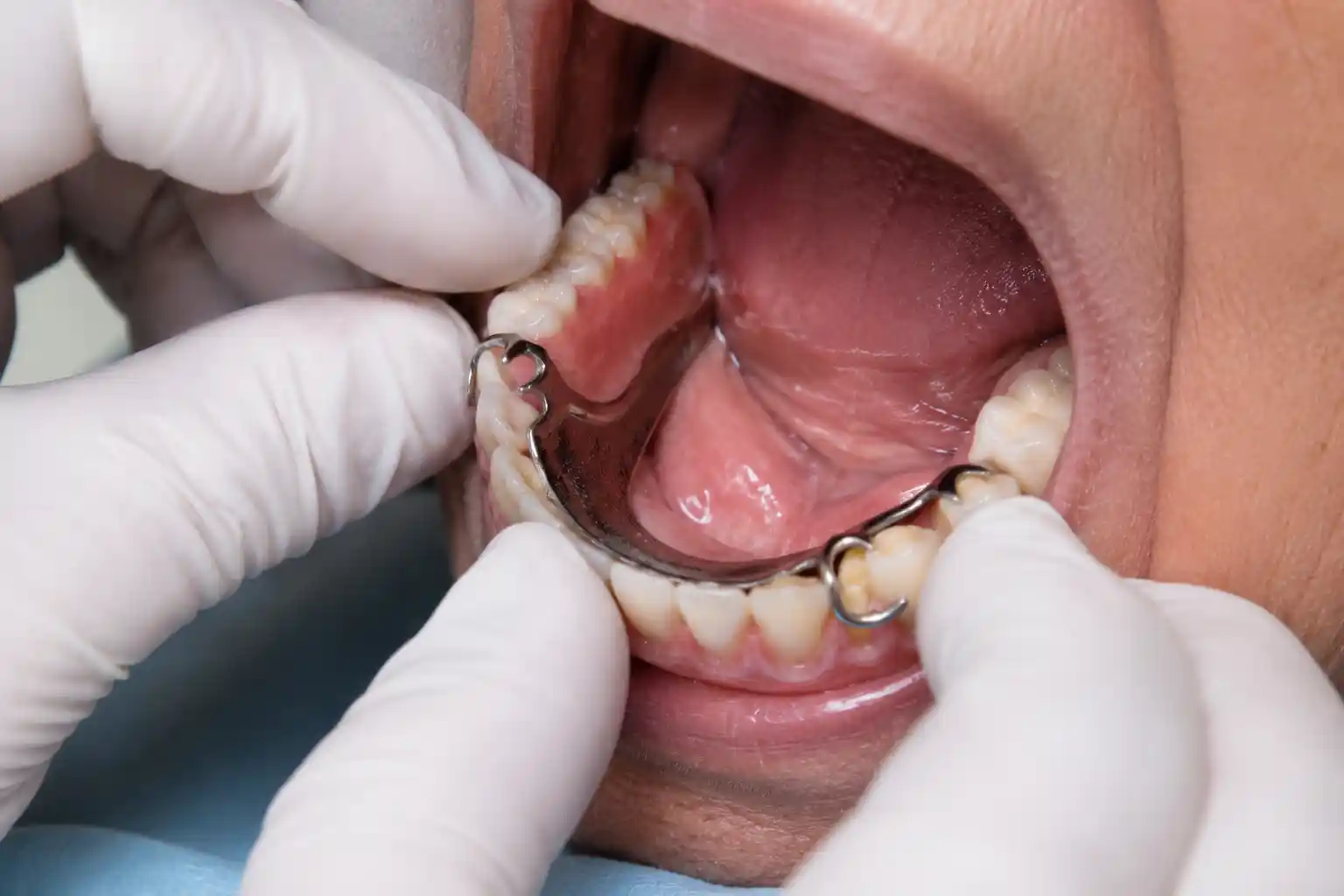 Dentures and partials fitted at Radiant 32 Dental Clinic