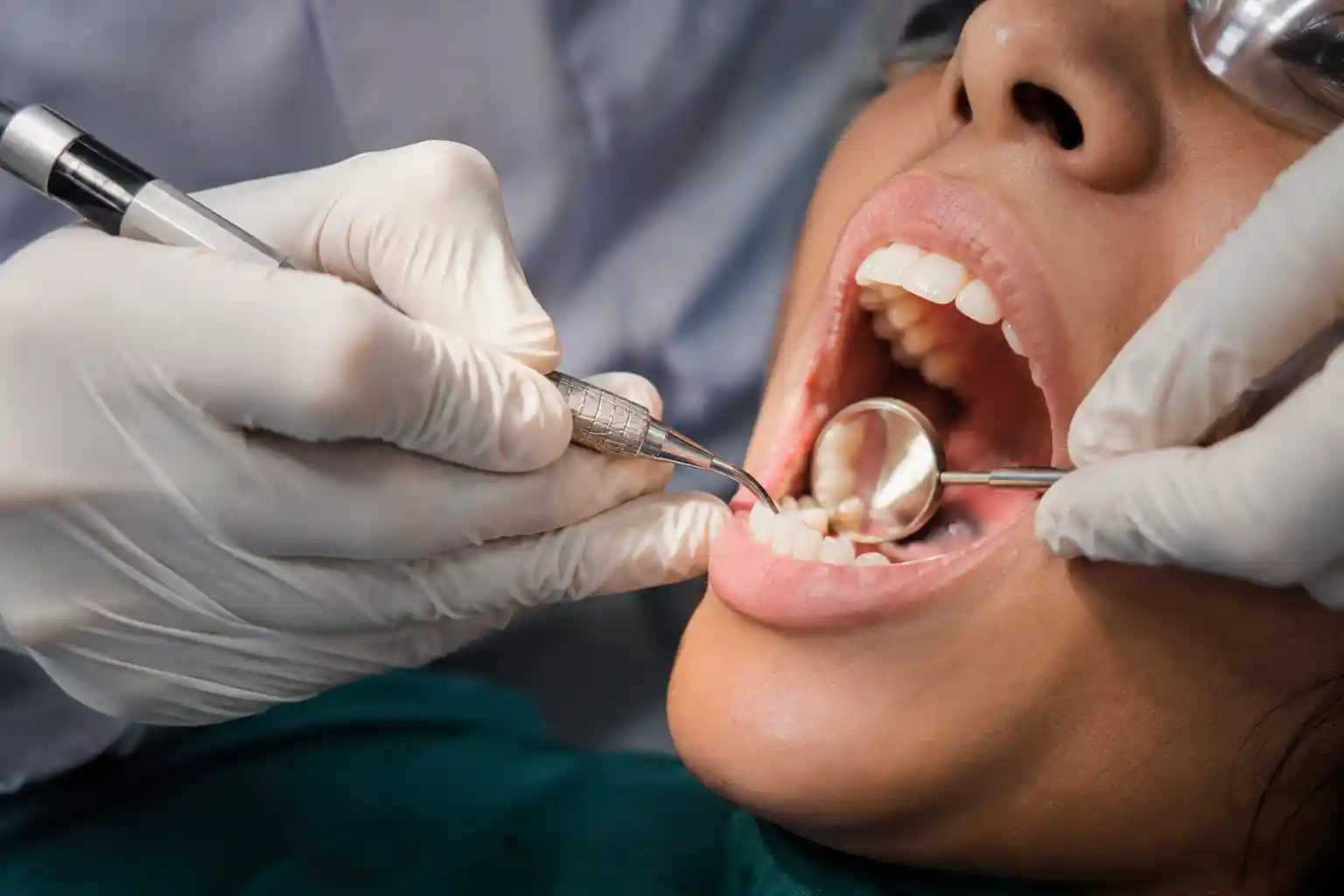 Scaling and polishing treatment at Radiant 32 Dental Clinic