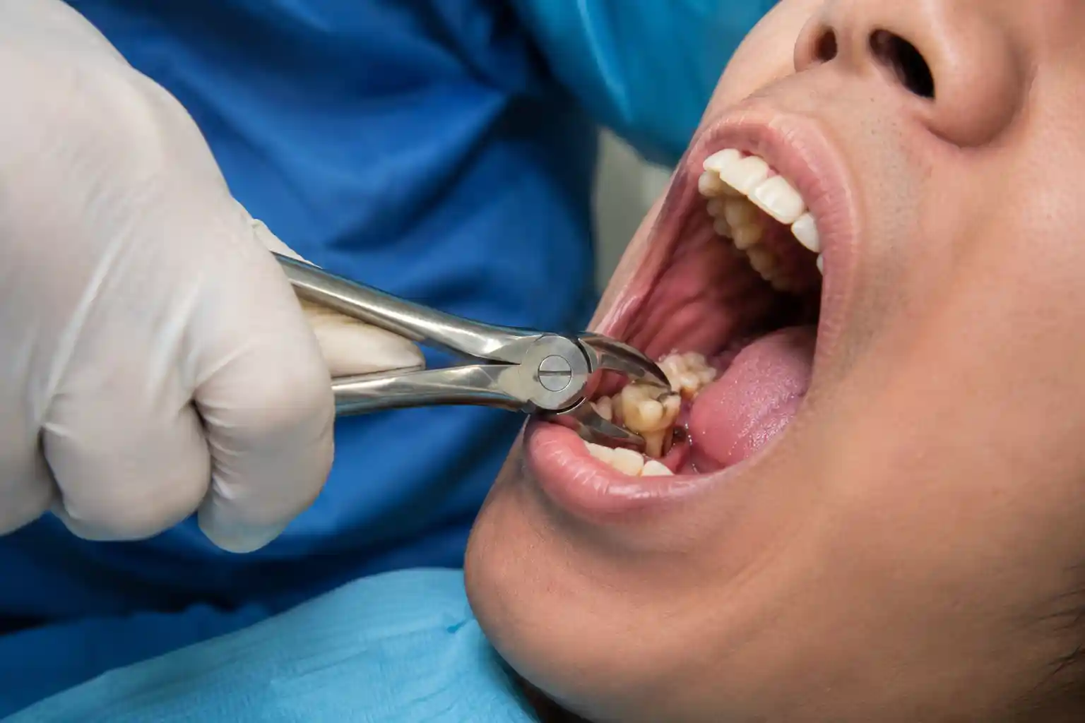 Tooth extraction at Radiant 32 Dental Clinic